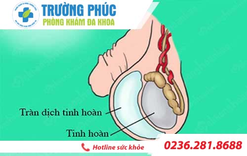 Ảnh hưởng tràn dịch màng tinh hoàn nam giới nên biết