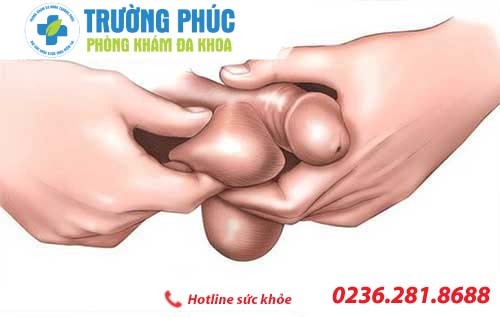 Bị yếu sinh lý do bị hẹp bao quy đầu