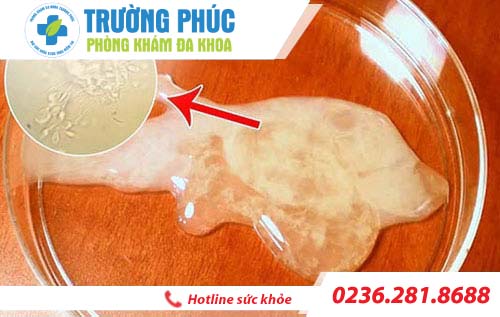 tinh trung loang va phuong phap ho tro dieu tri