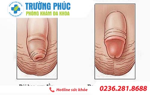 Làm sao để phân biệt dài bao quy đầu  và hẹp bao quy đầu ?
