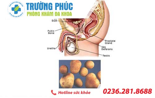 Cảnh báo dấu hiệu bệnh sỏi tuyến tiền liệt