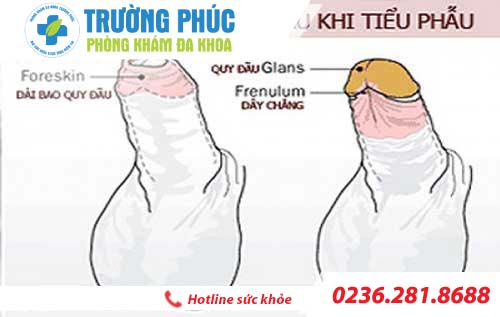 dai bao quy dau la do dau