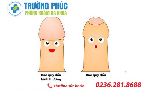 Dấu hiệu của dài bao quy đầu