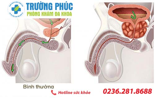 dau hieu phi dai tuyen tien liet