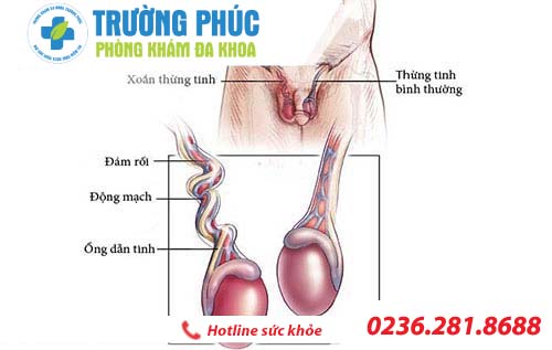 phuong phap ho tro dieu tri dau nhuc tinh hoan