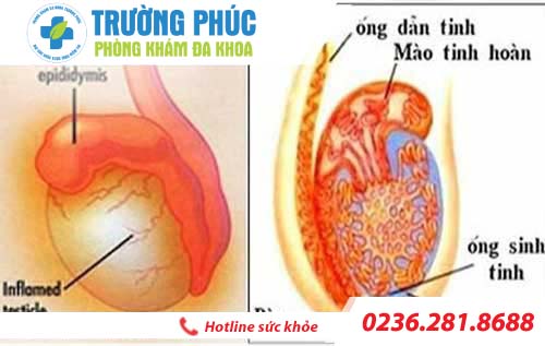dau tinh hoan co dan den vo sinh khong
