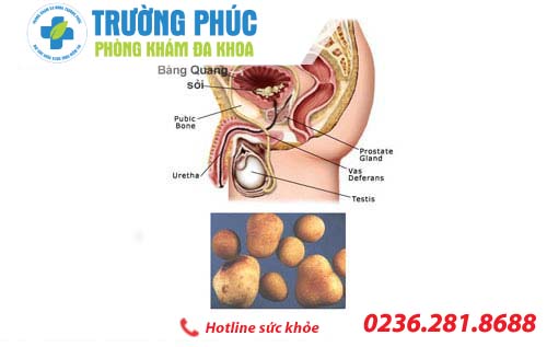 Địa chỉ trị sỏi tuyến tiền liệt đáng tin cậy
