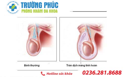 Điều trị tràn dịch màng tinh hoàn như thế nào?