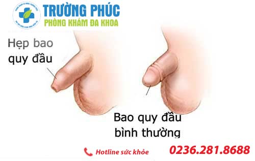 Hẹp bao quy đầu là gì? Làm sao để khắc phục?