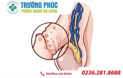 ngứa và nổi mụn ở dương vật ngua va noi mun o duong vat