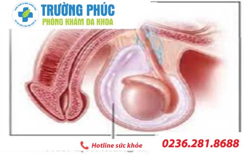 Nguyên nhân gây ra tràn dịch màng tinh hoàn ở nam giới