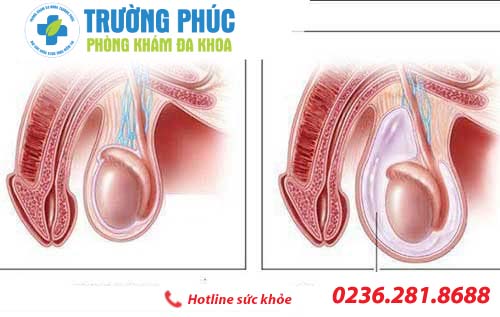 Những triệu chứng nguy hiểm của chứng tràn dịch màng tinh hoàn