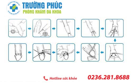 những trường hợp cần được cắt bao quy đầu nhung truong hop can duoc cat bao quy dau