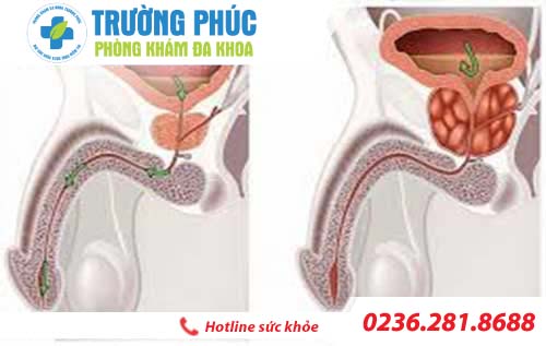 phi dai tuyen tien liet gay ra nhung tac hai nao