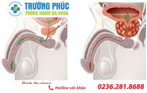 phì đại tuyến tiền liệt ở nam giới do đâu phi đai tuyen tien liet o nam gioi do dau