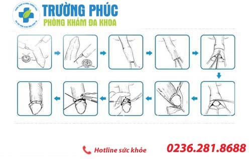Phương pháp cắt bao quy đầu hiệu quả