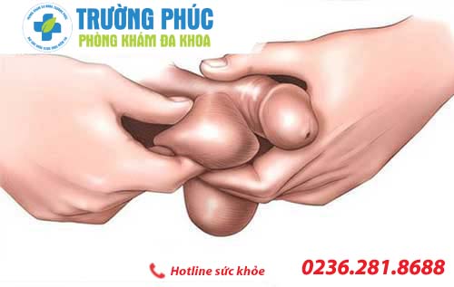 Phương pháp hỗ trợ điều trị lệch bìu hiện nay phuong phap ho tro dieu tri lech biu hien nay