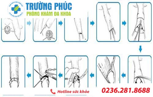 quy trinh cat bao quy dau