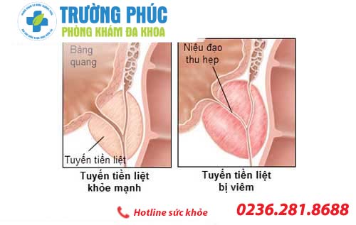 sưng một bên tinh hoàn - bác sĩ chuyên khoa tư vấn sung mot ben tinh hoan - bac si chuyen khoa tu van