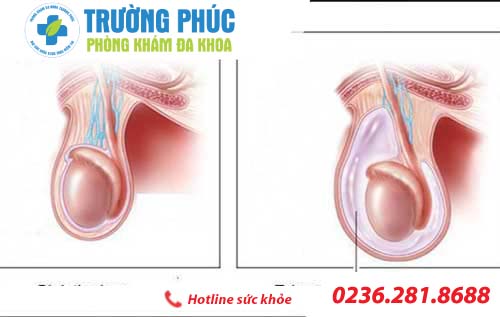 Tìm hiểu bệnh tràn dịch màng tinh hoàn tim hieu benh tran dich mang tinh hoan