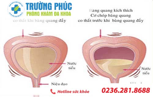 Triệu chứng bệnh viêm bàng quang ở nam giới
