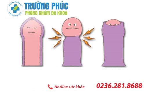 Triệu chứng của hẹp bao quy đầu