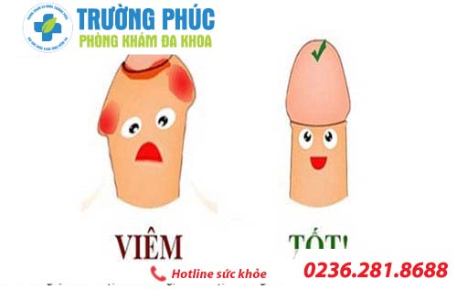 Triệu chứng bệnh viêm bao quy đầu thường gặp