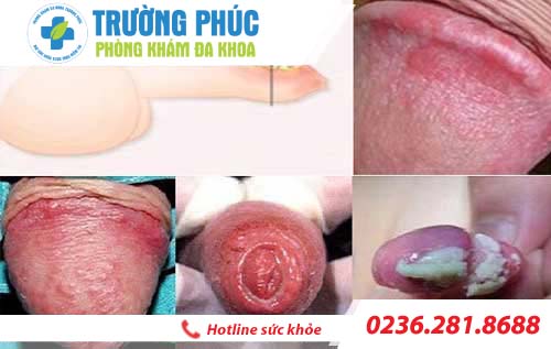 thông tin bệnh viêm dương vật thong tin benh viem duong vat