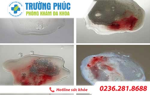 xuat tinh ra mau dau hieu cho nen xem nhe